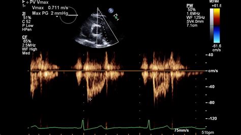 normal 2d echo result